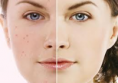 TRATAMIENTOS DE ACNE