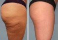 TRATAMIENTOS DE CELULITIS
