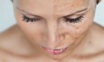 TRATAMIENTOS DE MELASMA, MANCHAS HYPERPIGMENTACIÓN